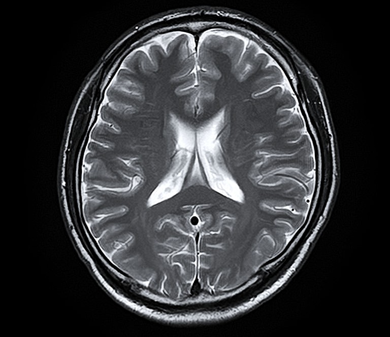 脳MRI・MRA診断画像2