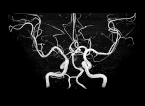 脳MRI・MRA診断画像4