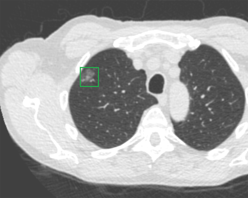 低線量肺CT診断画像2