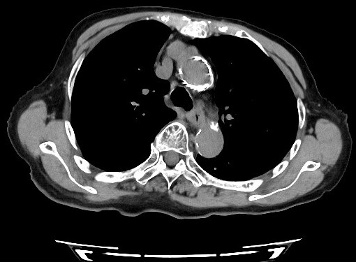 低線量肺CT診断画像1